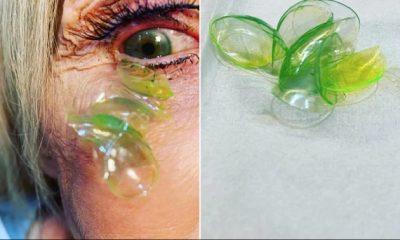 doctor-removing-23-contact-lenses-from-woman-eye