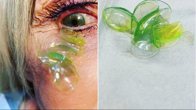 doctor-removing-23-contact-lenses-from-woman-eye