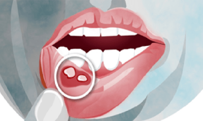 These 7 Causes of Oral Thrush and Mouth Sores, Know How Serious Neglect Can Be