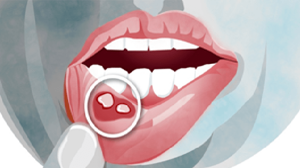 These 7 Causes of Oral Thrush and Mouth Sores, Know How Serious Neglect Can Be