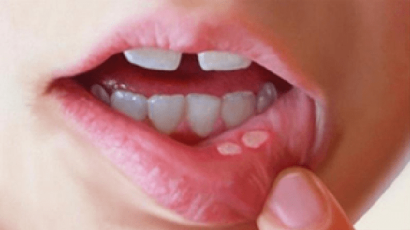 These 7 Causes of Oral Thrush and Mouth Sores, Know How Serious Neglect Can Be