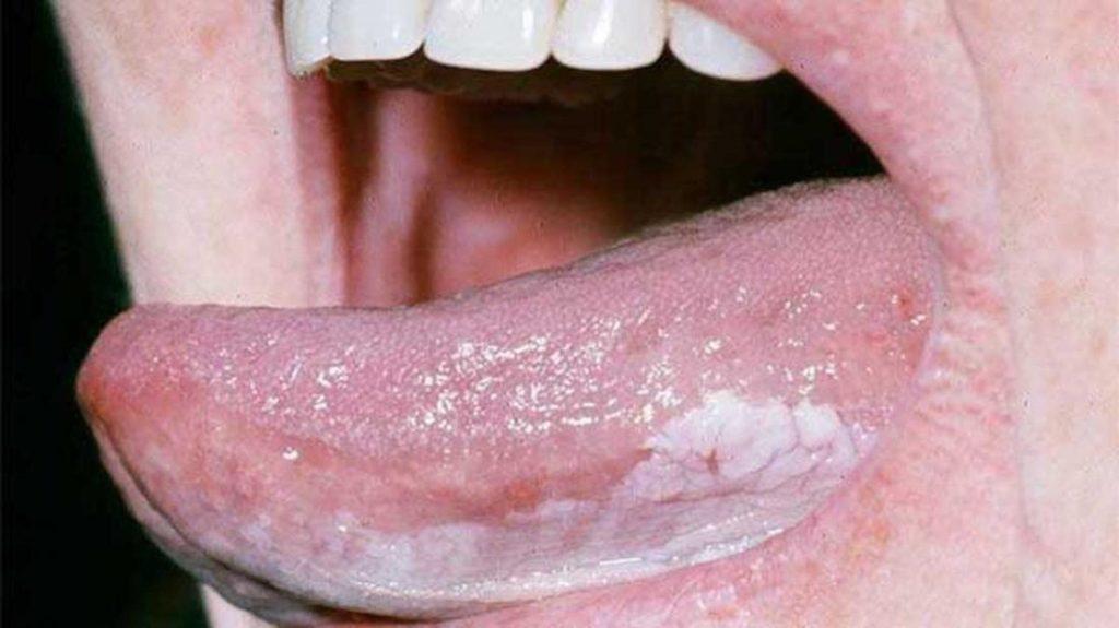 The color of the tongue will tell your health condition, know when you should go to the doctor