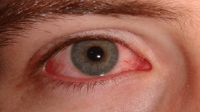 conjunctivitis-virus-is-spreading-through-the-eyes-and-nose